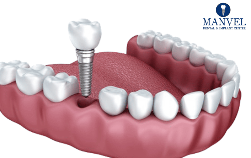 Implant Dentistry Manvel
