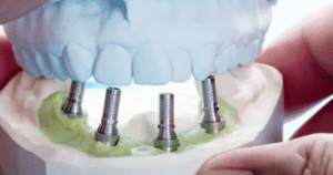 All-on-4 Dental Implants_ A Comprehensive Guide to a Permanent Smile