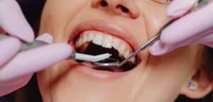 the importance of dental cleaning before valentines day