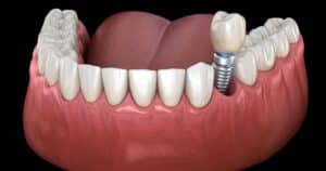 is a loose dental implant emergency