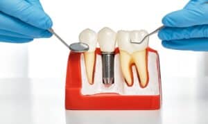 dental implants