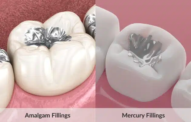 img-amalgam-fillings-proven-reliable-and-built-to-last