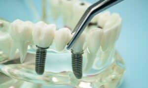 dental implants in Manvel