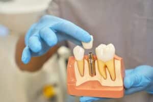 Dental Implants in Manvel
