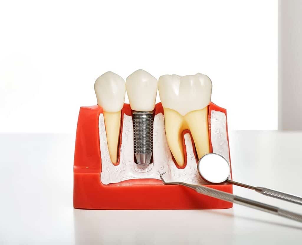 Dental Implants in Manvel
