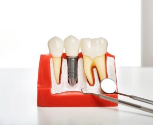 Dental Implants in Manvel